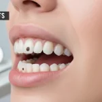 7-Causes-of-Black-Spots-on-Gums