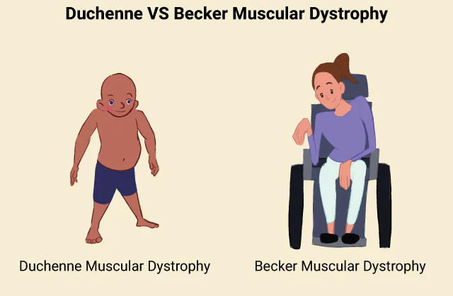 An illustration comparing Duchenne muscular dystrophy and Becker muscular dystrophy in children