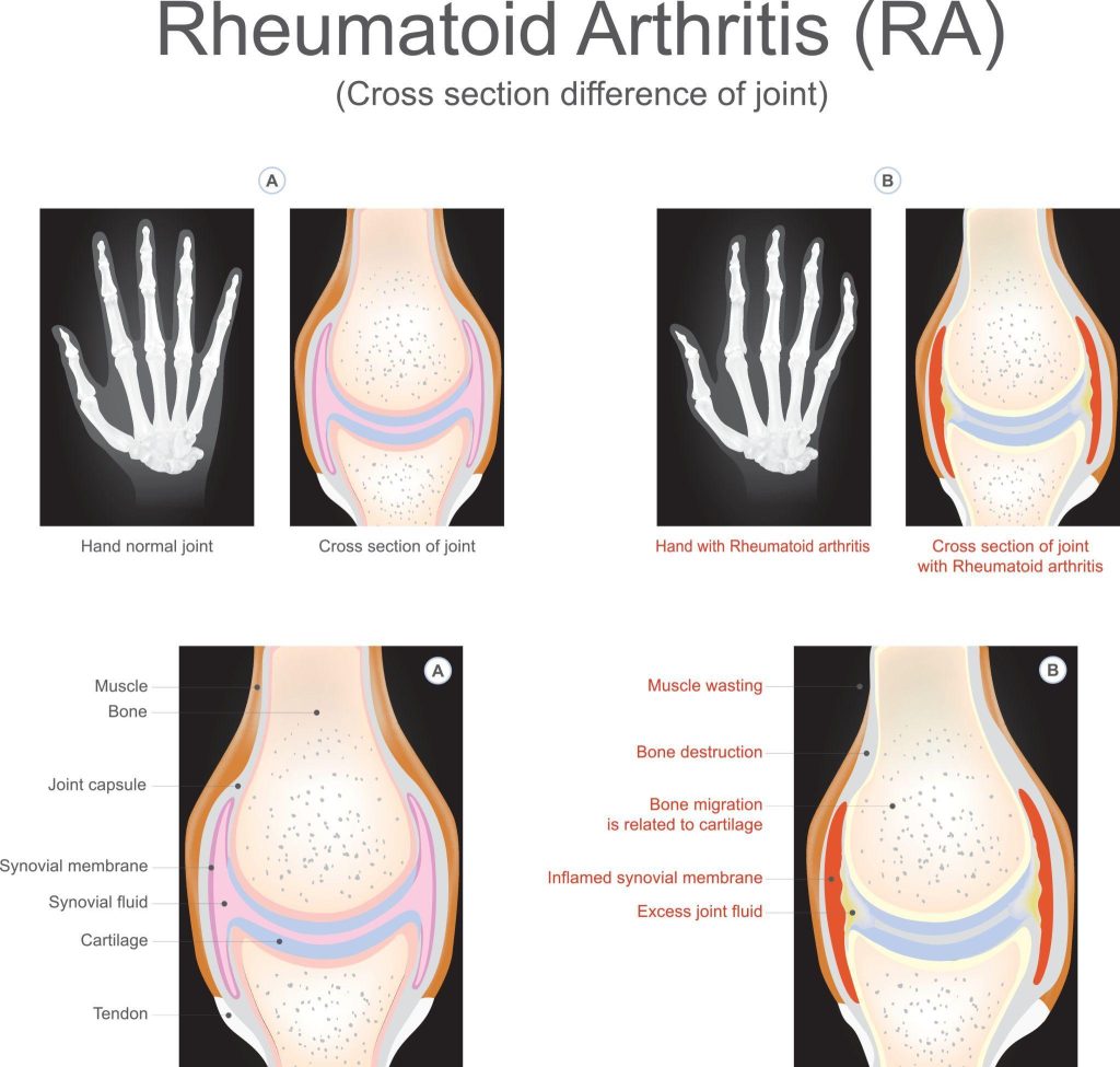 Normal joint vs Rheumatoid Arthritis joint cross section diagram